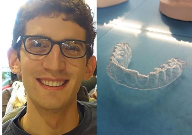 3D印刷牙套箍牙,省下六萬元