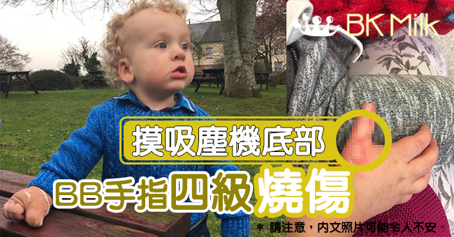 小心吸塵機！兒童受四級燒傷
