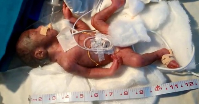 世界最小：1磅重，12吋高的奇蹟小男嬰