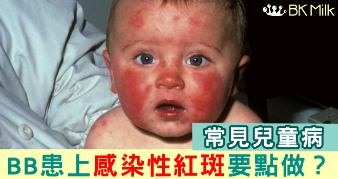 '給摑了兩巴'？孩子患感染性紅斑，要怎樣做…