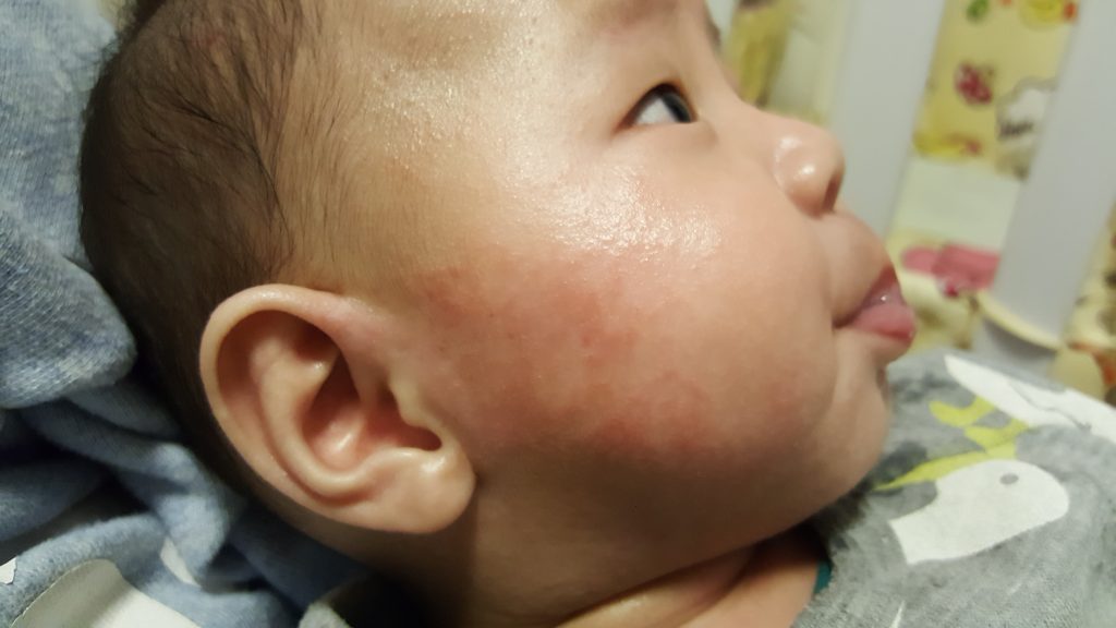 細佬B濕疹大作戰 !