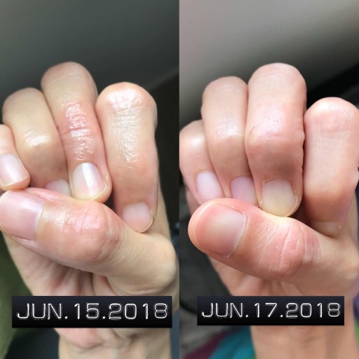 我的手濕疹又痕又絕不能抓! 3步DIY防敏洗手液