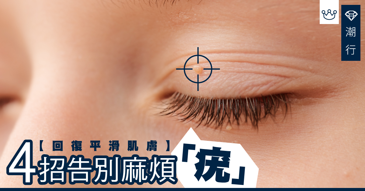 撫平脆弱肌膚 4招告別麻煩「疣」！