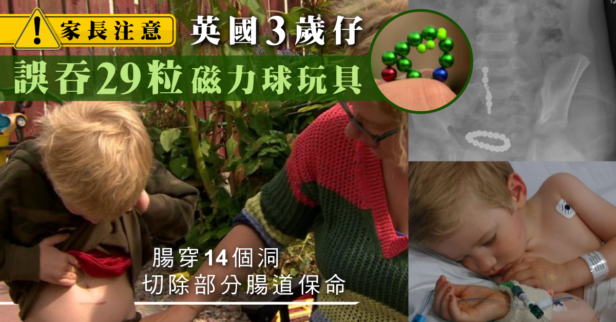 【家長注意】英國3歲仔誤吞磁力球玩具 腸穿肚爛要切除部分腸道保命