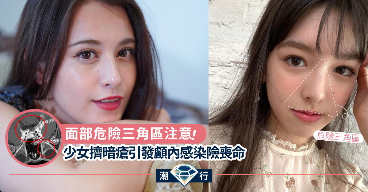 【護膚常識】臉上的危險三角區!少女擠壓暗瘡引發顱內感染險喪命