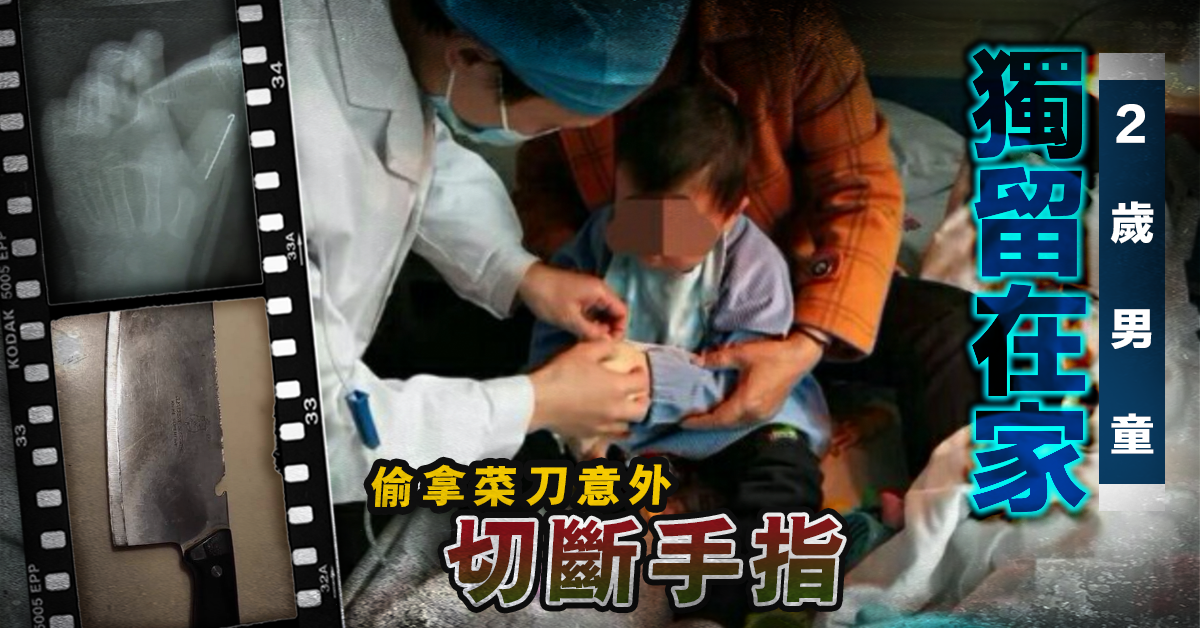 【獨留在家】2歲男童偷拿菜刀模仿大人做菜 意外切斷大拇指