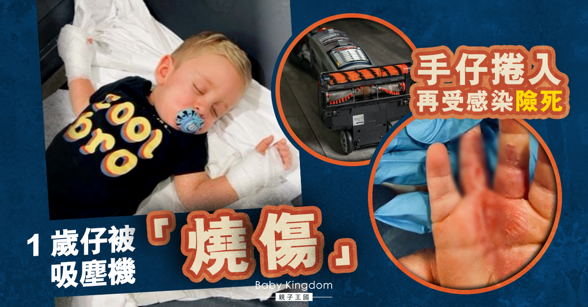 【家居陷阱】1歲男童誤開吸塵機 手仔被捲入再受感染險死