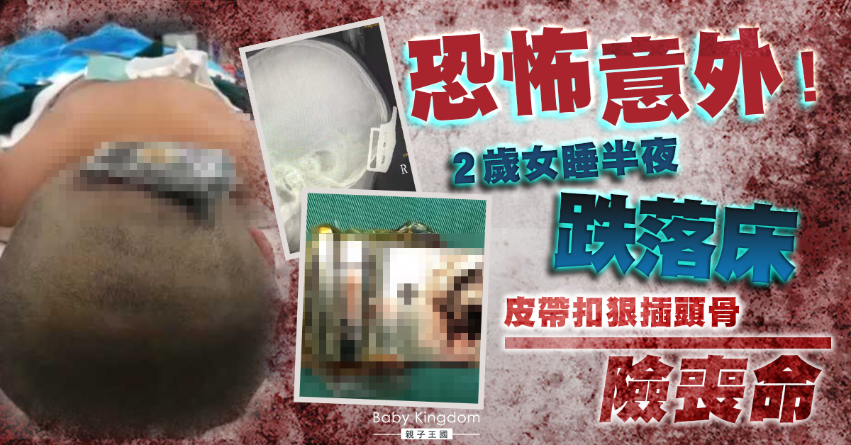 【家居意外】2歲女睡覺不慎摔下床 皮帶扣插入頭骨險喪命