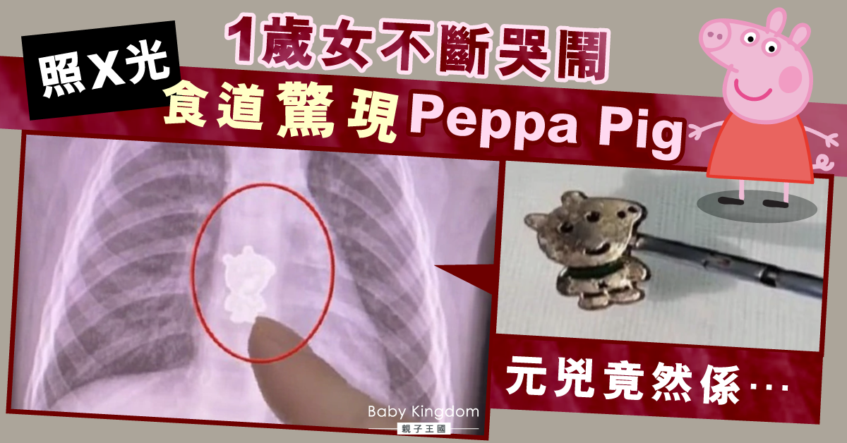 【家長注意】1歲女哭鬧兼咳嗽有血絲急求醫 體內驚現Peppa Pig!