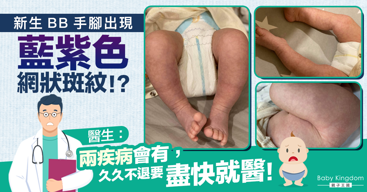 【家長注意】新生BB手腳出現藍紫色網狀紋 醫生勸久不退要就醫