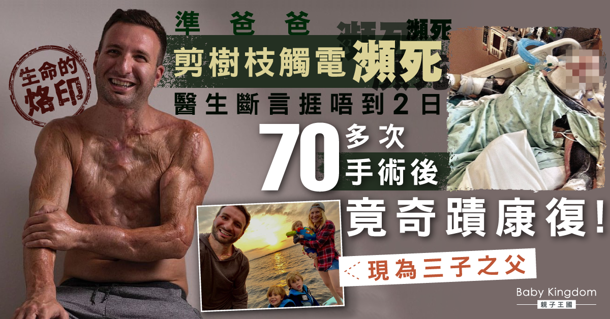 準爸爸觸電險亡 70多次手術後奇蹟康復：今後盡我所能做任何事！