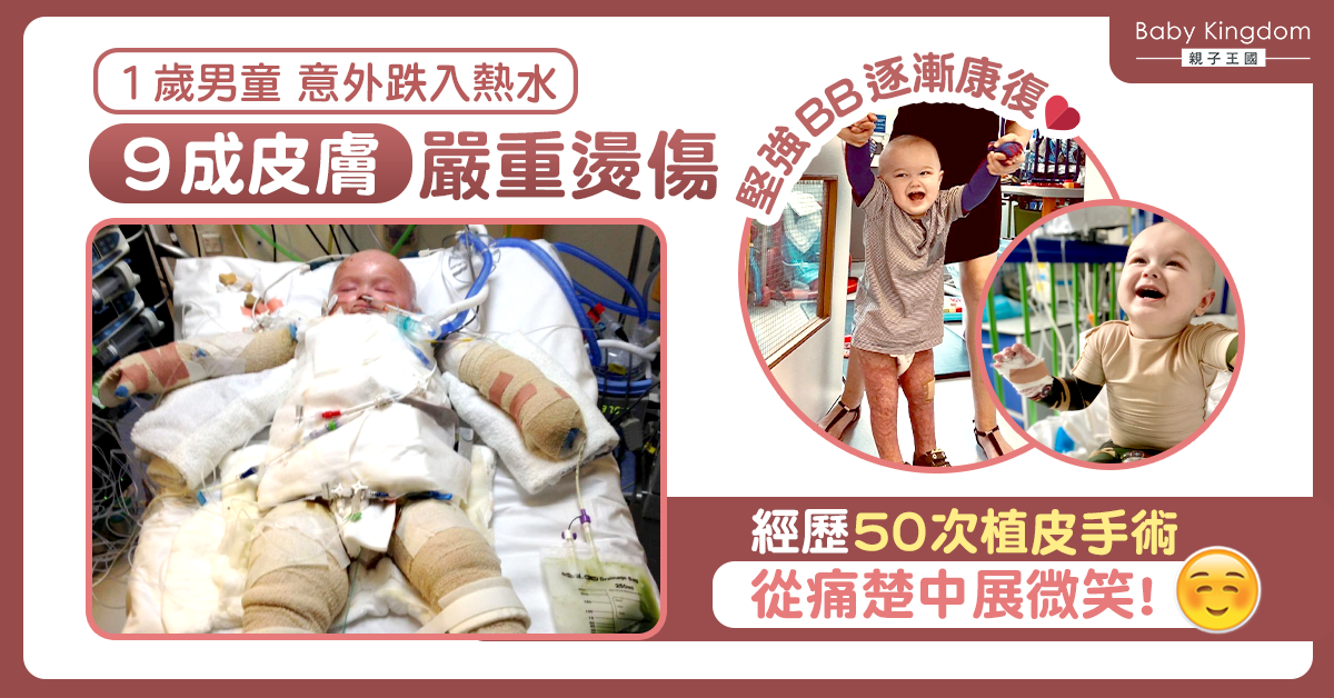 1歲兒不慎跌進熱水致9成皮膚嚴重燙傷 經歷50次手術仍笑容滿面！