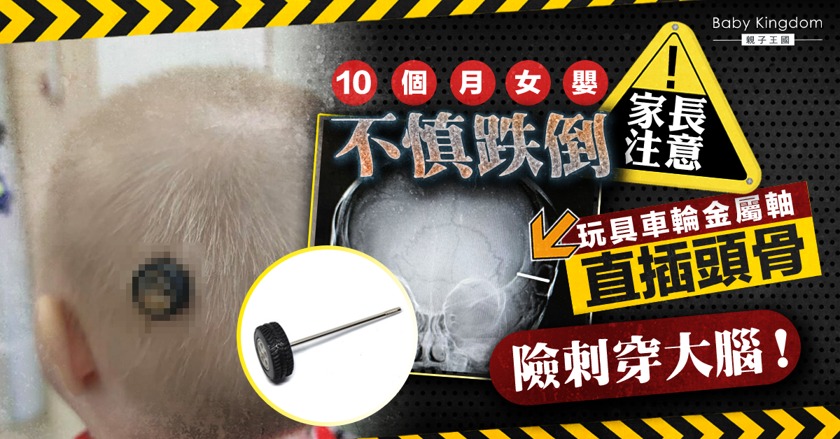 【玩具意外】10個月大女嬰不慎跌倒 玩具車輪金屬軸插入頭骨險刺穿大腦