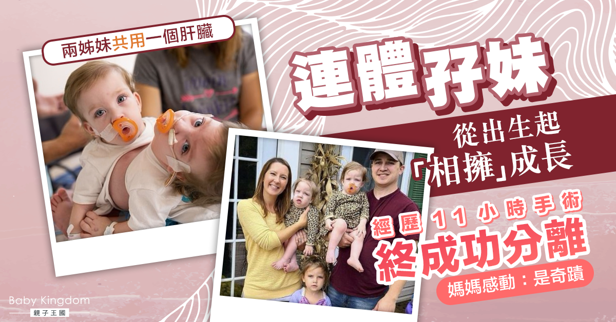 【生命奇蹟】1歲連體孖妹相擁成長 經11小時手術成功分離
