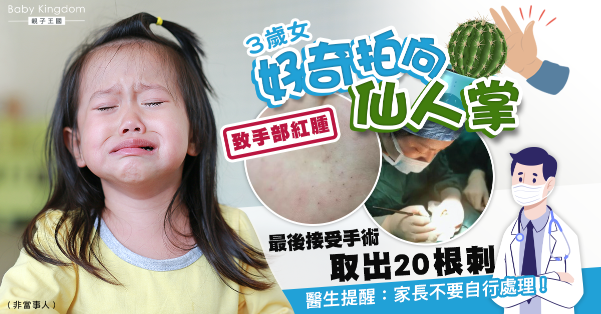 3歲百厭女拍打仙人掌致手掌紅腫 經手術拔出20多條刺