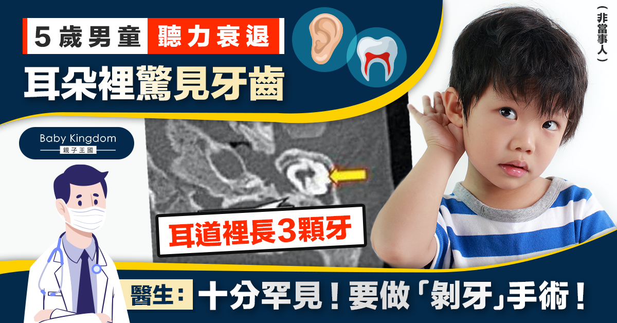 5歲男童聽力不佳全因耳朵長出牙齒 醫生:須「拔牙」重建聽力