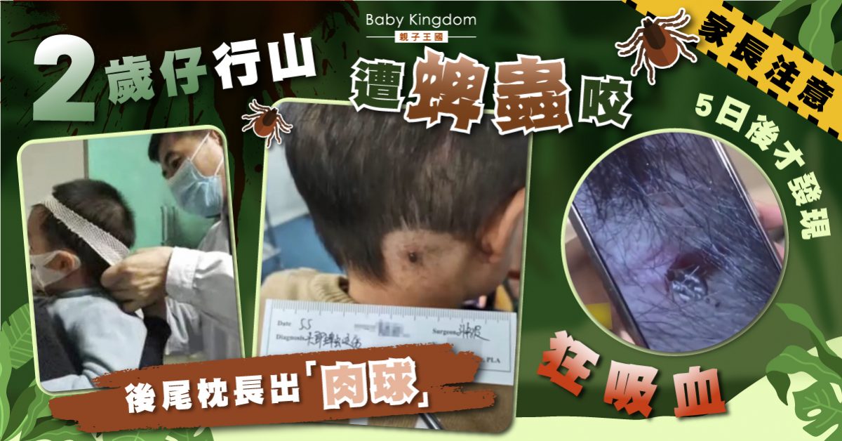 【家長注意】2歲仔行山遭蜱蟲咬後頸 家人5日後才發現生「肉球」