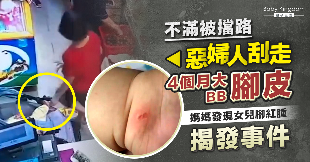 【家長留意】不滿被BB車擋路 惡婦人刮走4個月大女嬰腳皮