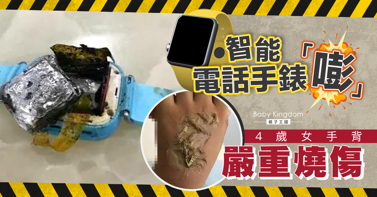 【家長注意】電話手錶突爆炸自燃 4歲女童手背嚴重燒傷
