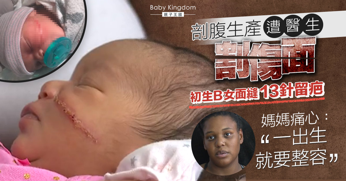 【罕見意外】剖腹生產遭醫生割傷面  初生女嬰面縫13針留疤  爸媽極心痛