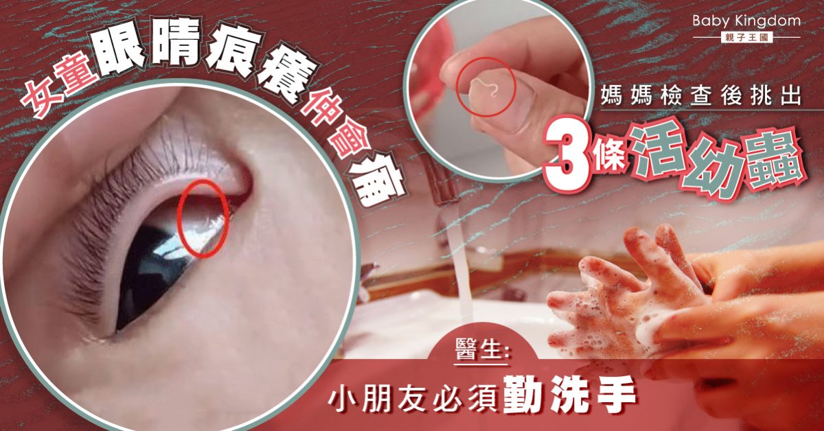 【寄生蟲】女童眼晴痕癢疼痛 媽媽檢查後竟挑出3條活幼蟲