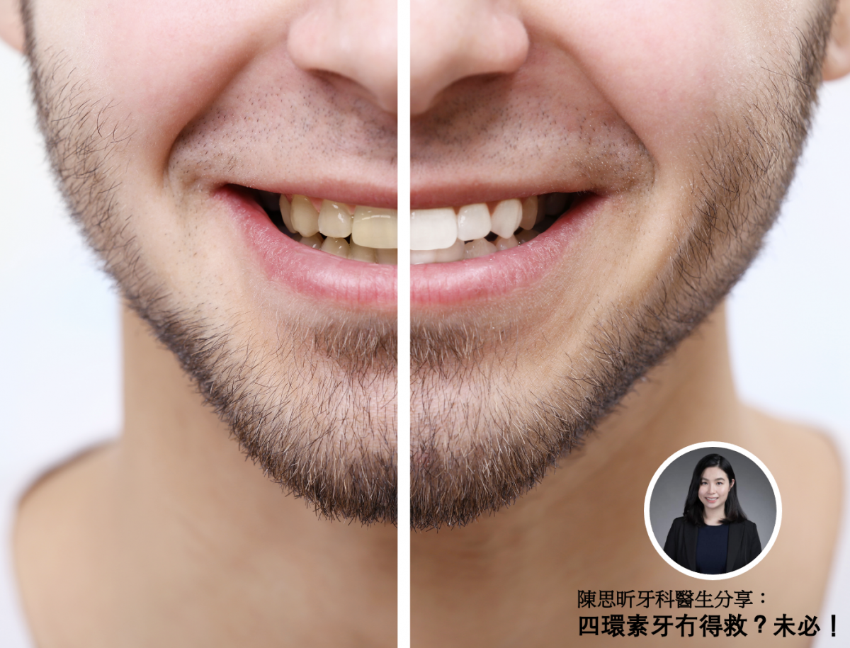 【牙科迷思】四環素牙冇得救？未必！