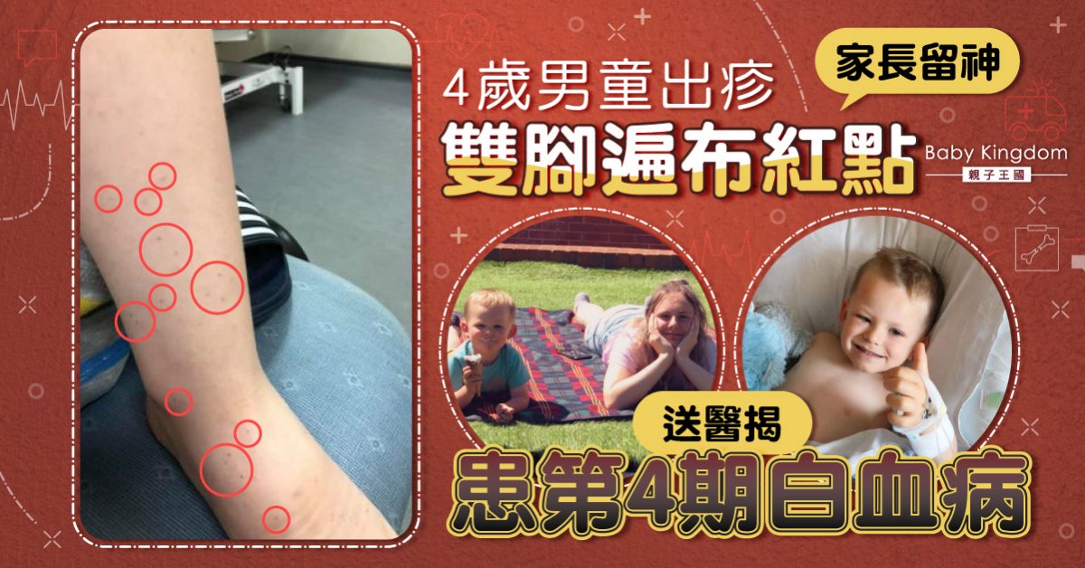 【家長留神】4歲男童雙腳長點狀紅疹 送院證實患第4期白血病