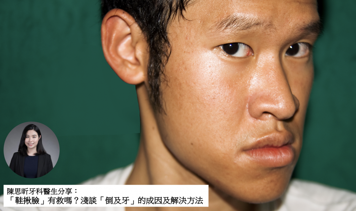 【牙科迷思】「鞋揪臉」有救嗎？淺談「倒及牙」的成因及解決方法