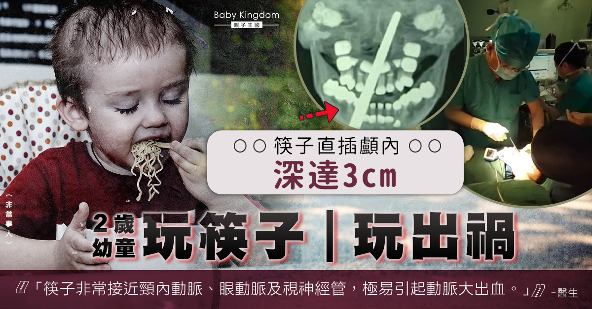 【家長注意】2歲幼童玩筷子摔倒 筷子直插顱內3cm 險引起動脈大出血