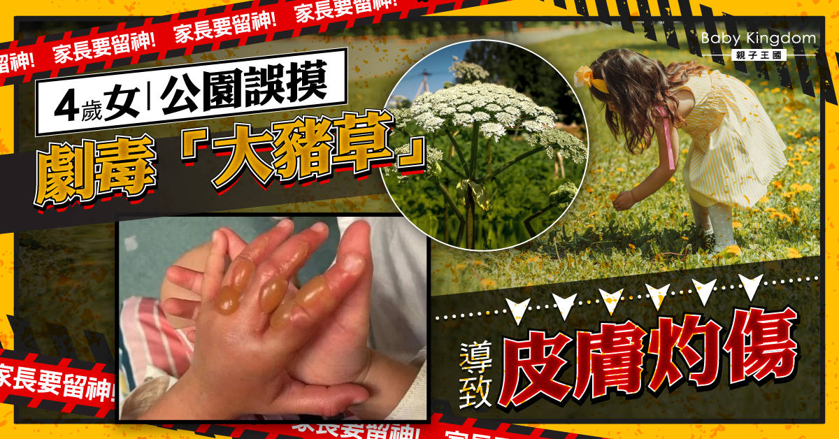 【家長留神】4歲女公園誤觸劇毒植物 導致手部三度灼傷