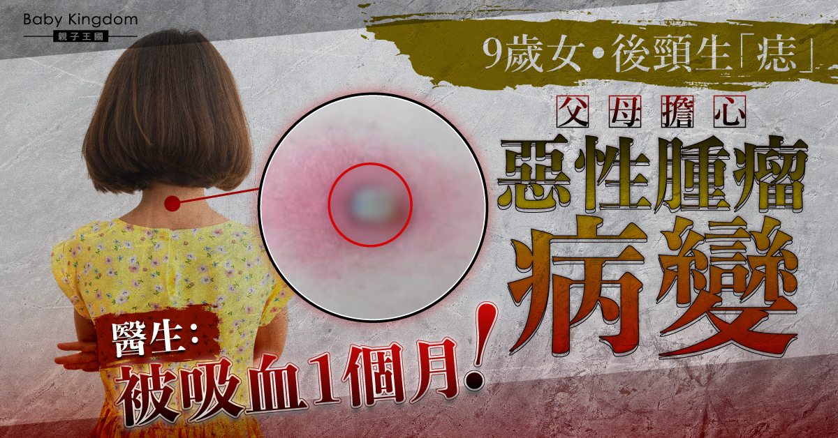【家長注意】9歲女後頸生「痣」誤以為惡性腫瘤 醫生：被吸血1個月