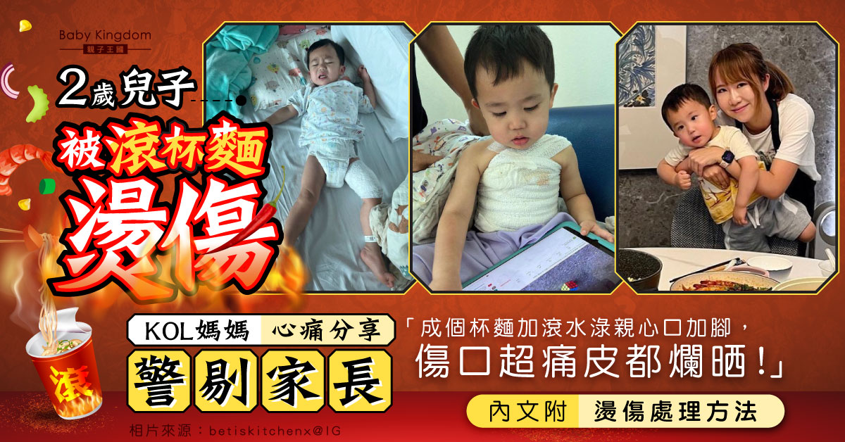 【家居意外】兒子被滾杯麵燙傷致2級燒傷 KOL媽媽心痛︰傷口皮都爛晒！