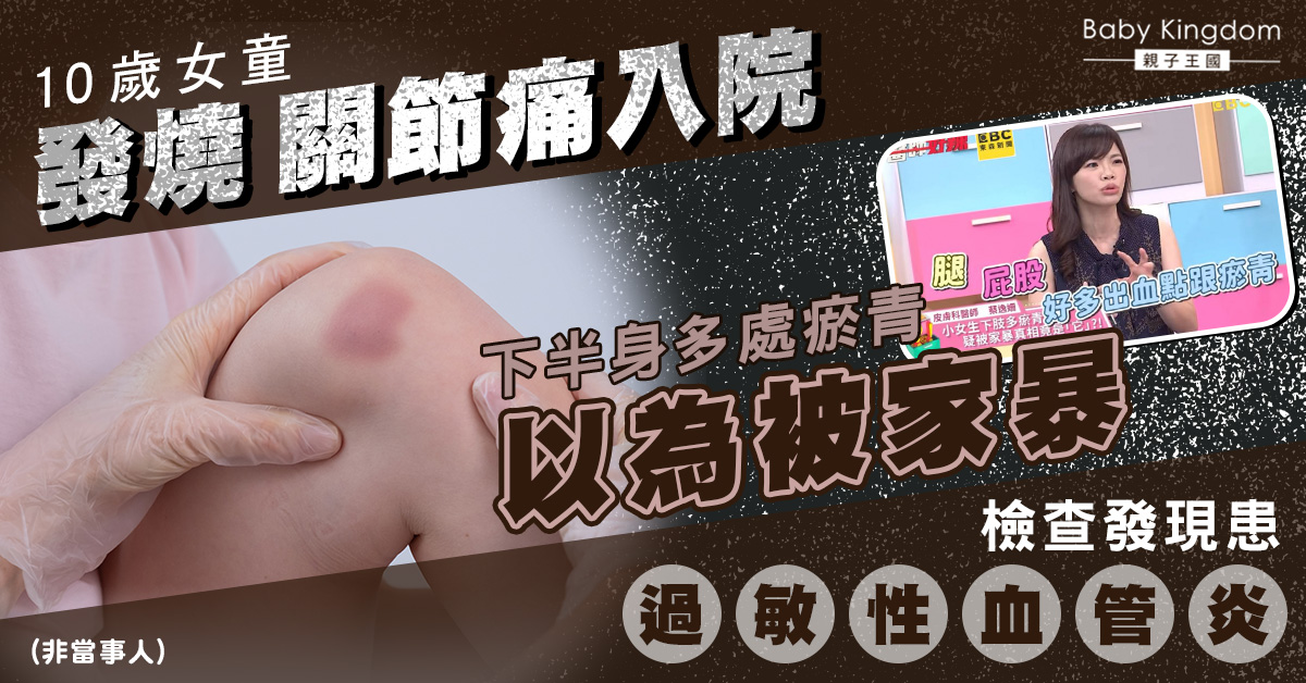 女童發燒住院驚見下肢多處瘀青以為被家暴 檢查發現患「過敏性血管炎」