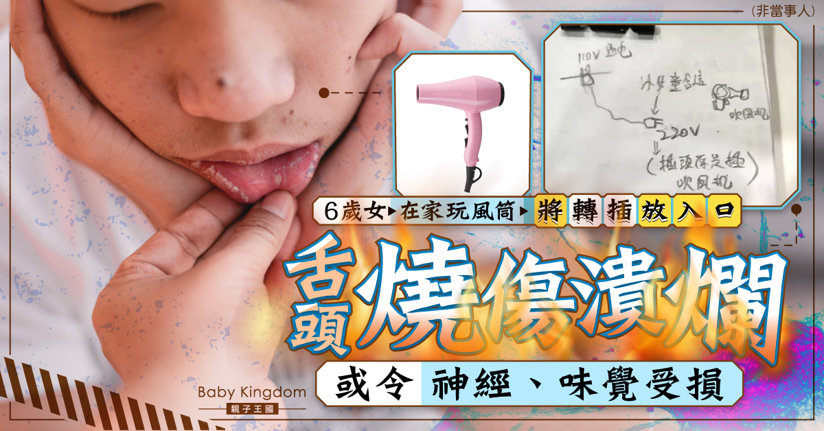 【家居安全】6歲女玩風筒將轉插放入口 舌頭燒傷潰爛恐傷味覺神經