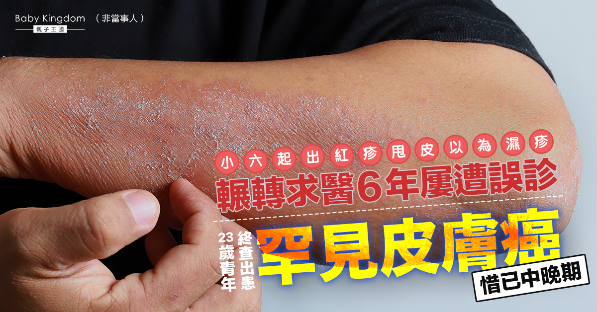 小六起出疹甩皮以為濕疹 23歲青年求醫6年始揭患癌惜已中晚期