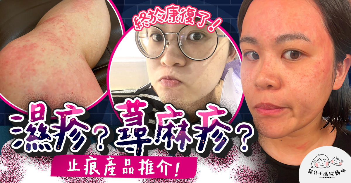 【小編大力皮膚爛了】慎入！內有搽類固醇腫面醜相 ?  慢性風癩痕到崩潰！誤當濕疹皮炎醫