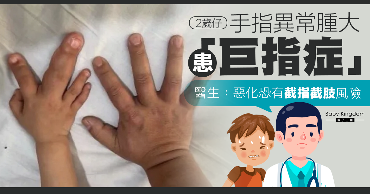 2歲仔手指異常腫大患「巨指症」 醫生:若延遲就醫恐要截指