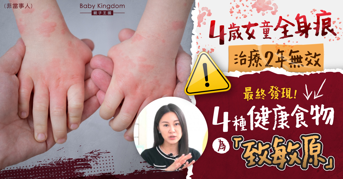 【兒童健康】4歲女全身痕 治療2年無效！4種健康食物竟為致敏原