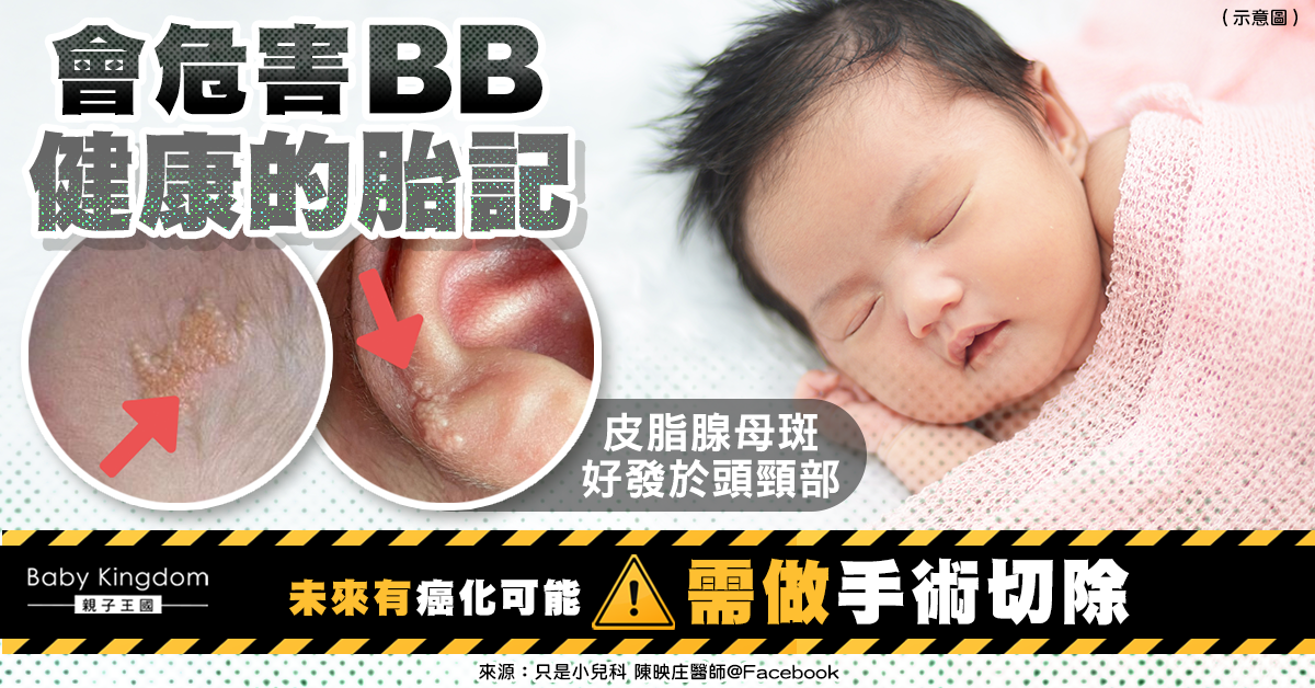 【爸媽必讀】一種胎記會危害寶寶健康 好發於頭頸部 或演變成癌症