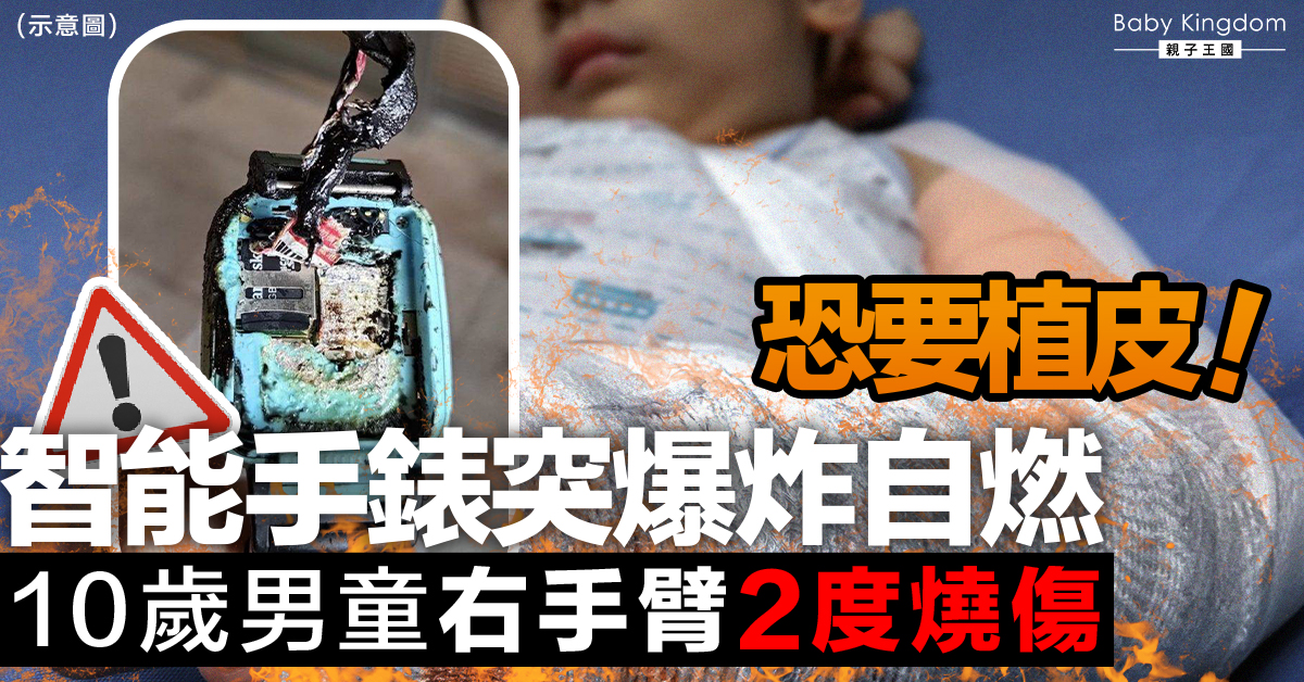 【家長注意】智能手錶突然爆炸自燃 男童2度燒傷恐須植皮