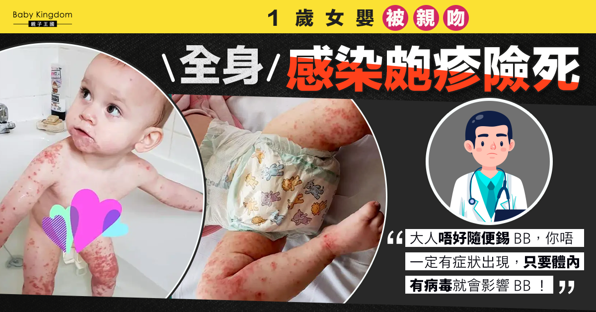 【兒童健康】疑被患唇瘡大人親吻 1歲B女全身感染皰疹險死