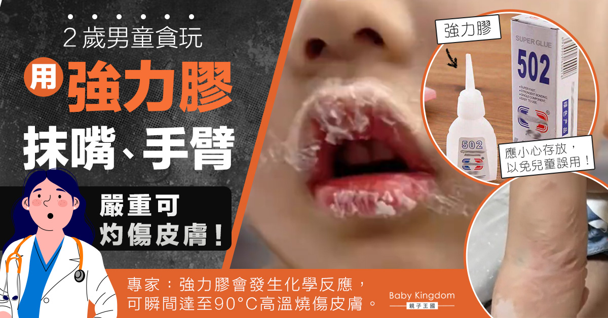 【家居安全】2歲男童趁父母不注意用強力膠抹嘴 專家提醒:嚴重可灼傷皮膚