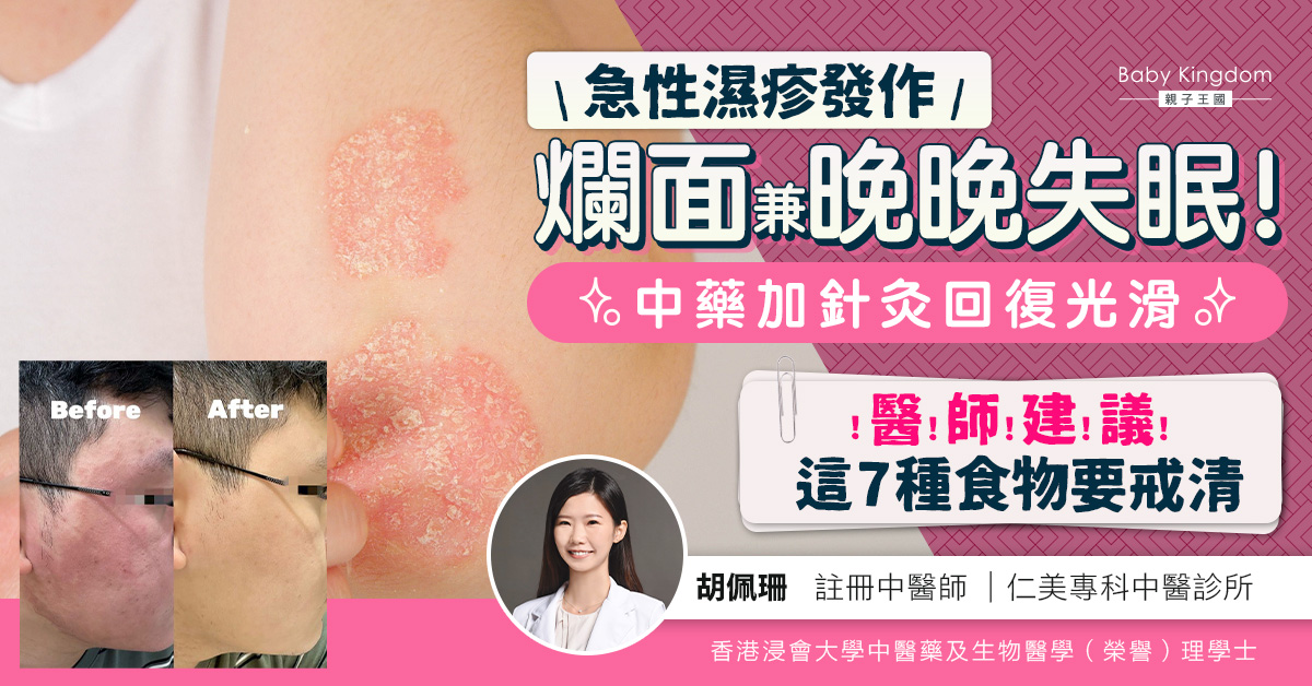 急性濕疹發作爛面兼晚晚失眠!中藥加針灸回復光滑 醫師建議這7種食物要戒清