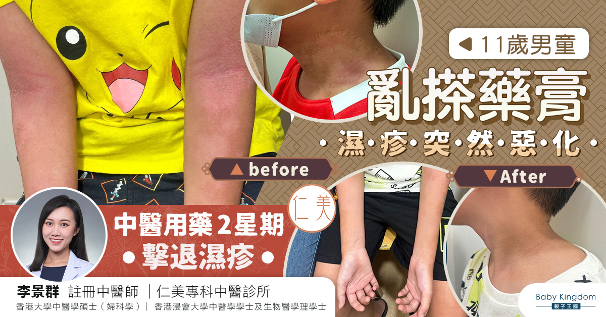 11歲男童亂搽藥膏濕疹突然惡化 中醫用藥2星期擊退濕疹 醫師：藥膏種類越簡單越好