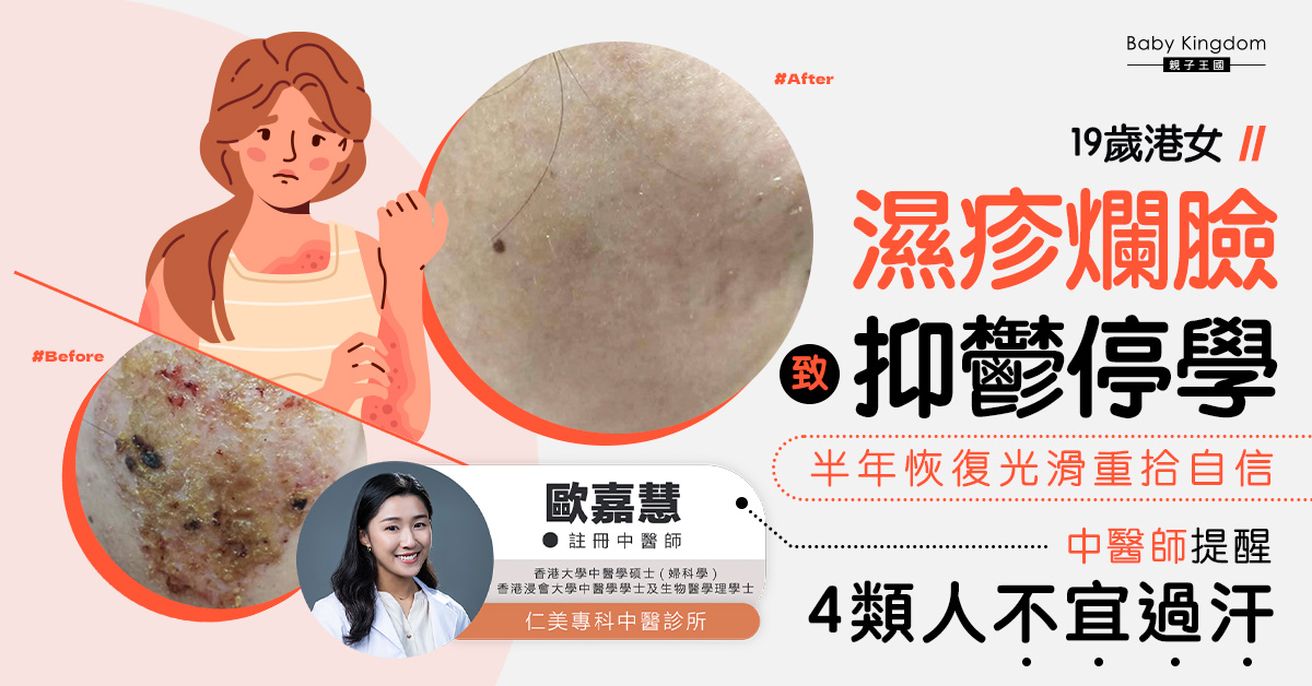 19歲港女濕疹爛臉致抑鬱停學  半年恢復光滑重拾自信