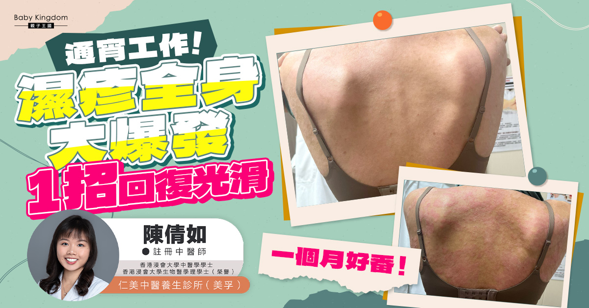 通宵工作濕疹全身大爆發 一招短時間內回復光滑