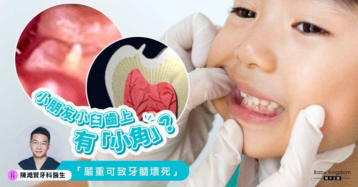 【牙齒健康】小臼齒上有「小角」？嚴重可致牙髓壞死
