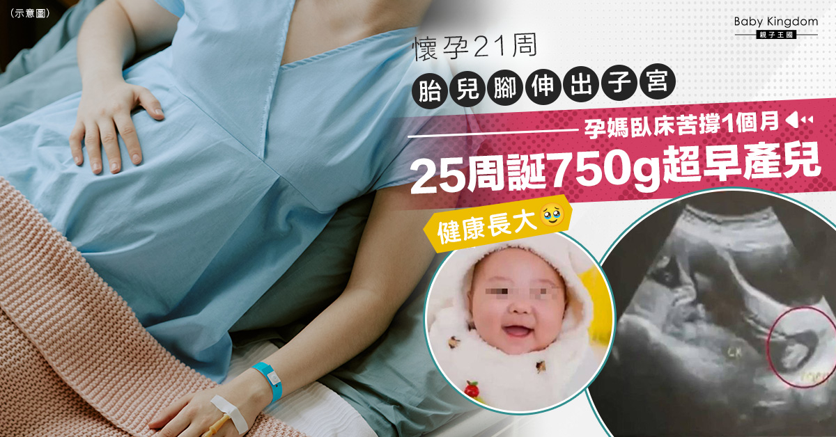 【超早產兒】21周胎兒腳伸出子宮 孕媽苦撐1月誕下750克超早產兒