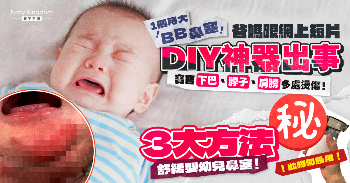【兒童健康】家長誤信網上教學「自製蒸鼻器」出事 1個月大寶寶多處燙傷送院治療！