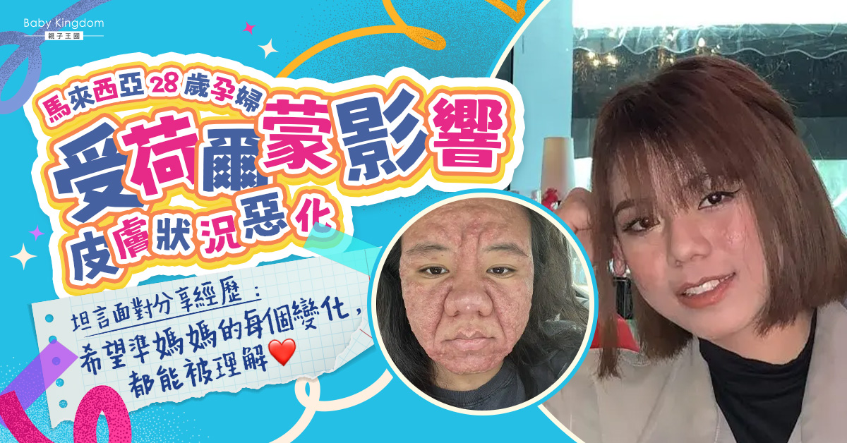 孕婦無懼皮膚劇變　公開相片勉勵同路人︰希望公眾理解媽媽辛酸